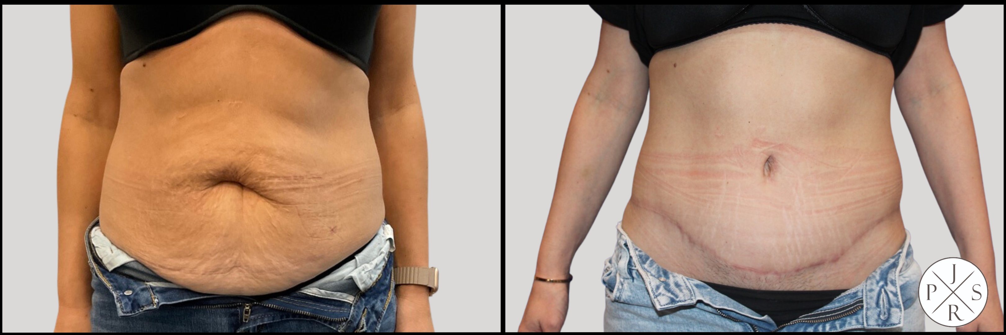 Abdominoplasty Before & After Image